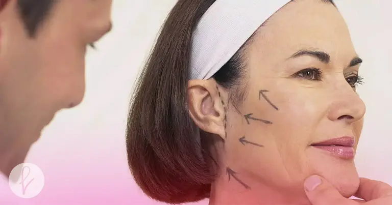 Cuáles son los beneficios de un Facelift