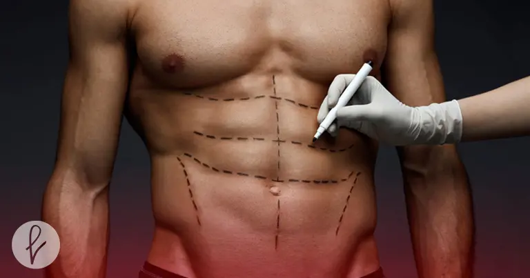 ¿Qué es la lipoescultura para hombres?