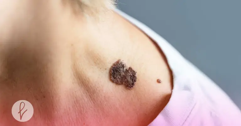 Beneficios de la extracción de lunares y tumores cutáneos