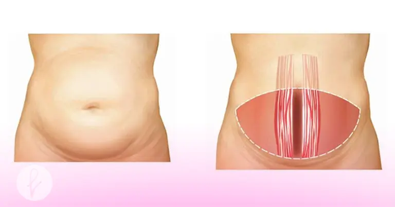 ¿Qué es la abdominoplastia? 