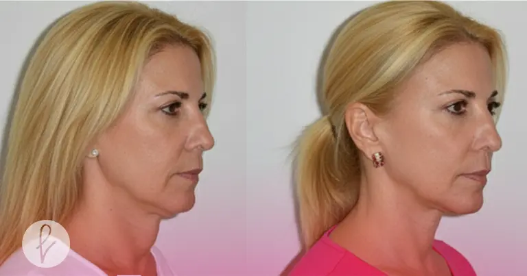¿Qué es el lipofilling facial? 