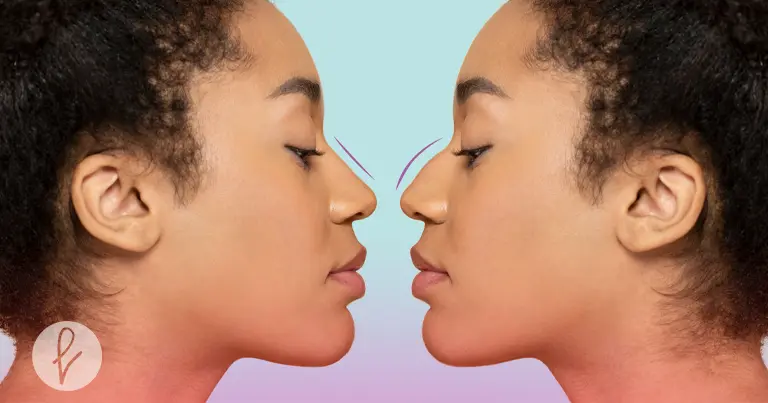 ¿Qué es la rinoplastia?