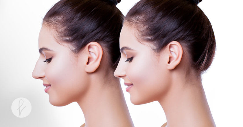 ¿Qué es la rinoplastia en Surco?