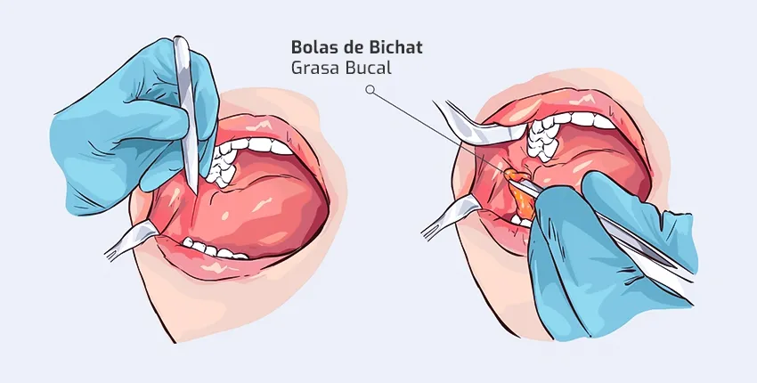 Procedimiento de la Bichectomía Procedimiento de la Bichectomía