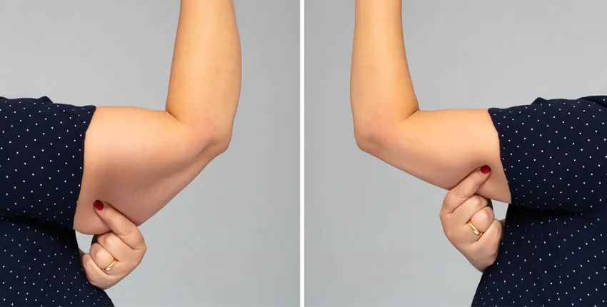 Resultados de la Braquioplastia