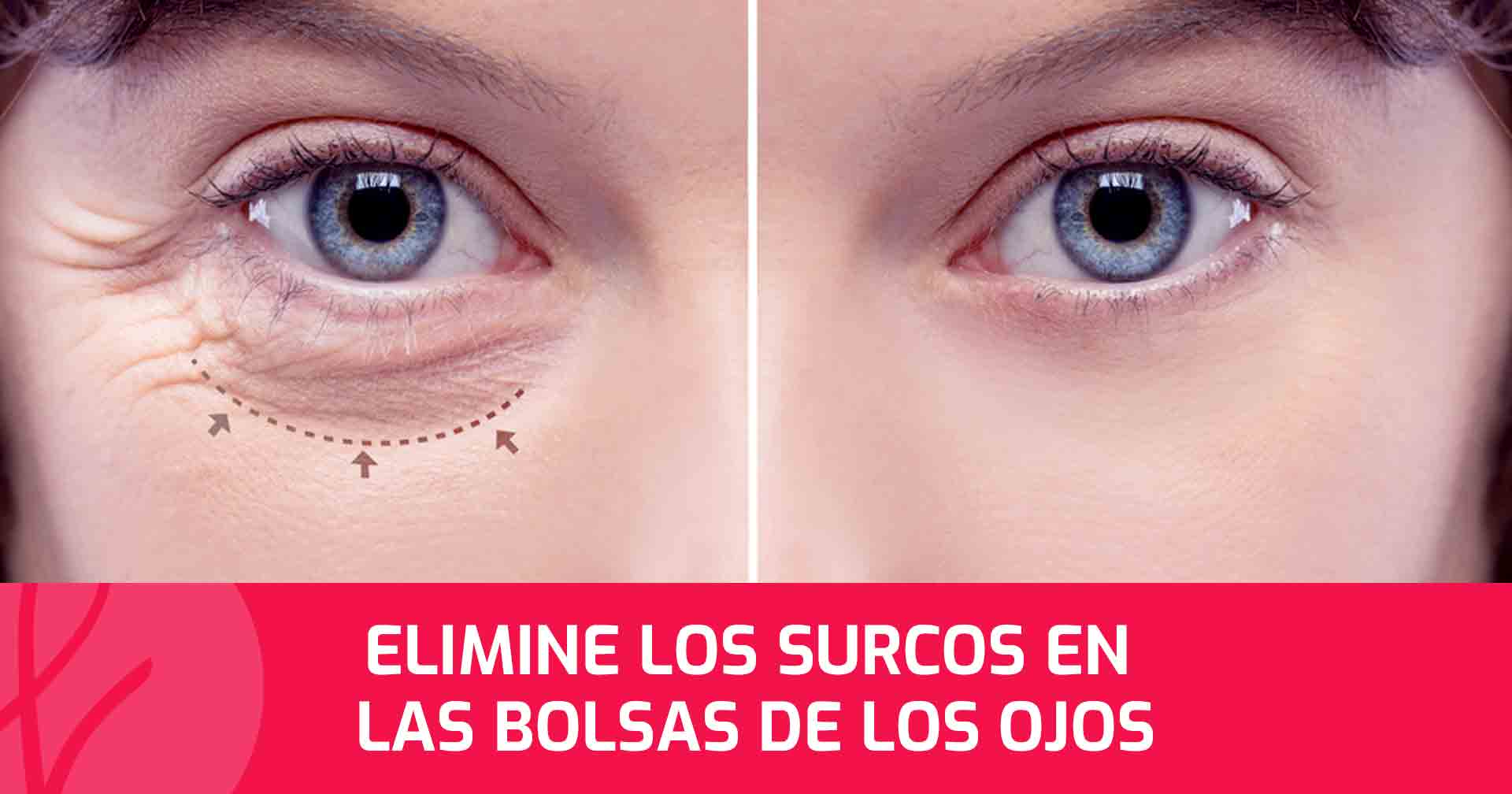 Elimine los Surcos en las Bolsas de los Ojos