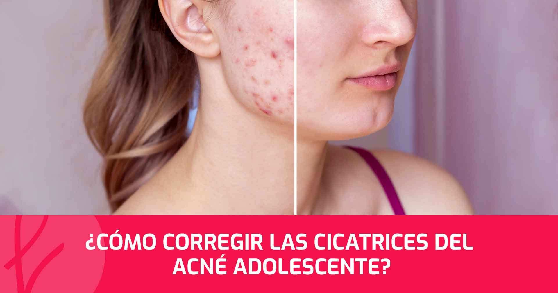¿Cómo corregir las cicatrices del acné adolescente?