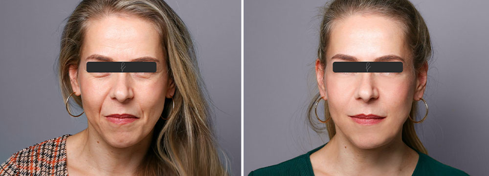 Resultados del Lifting Facial