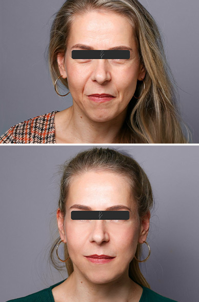 Resultados del Lifting Facial