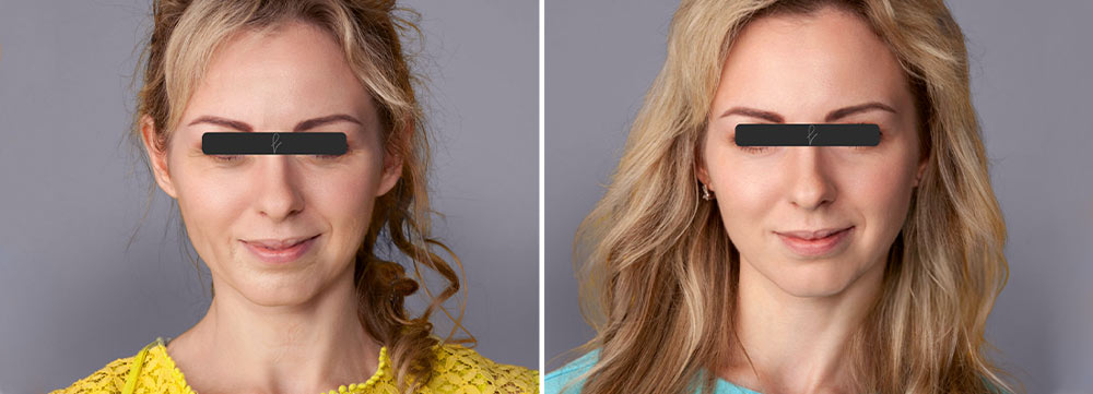 Resultados del Lifting Facial