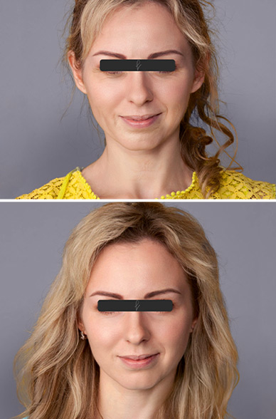 Resultados del Lifting Facial