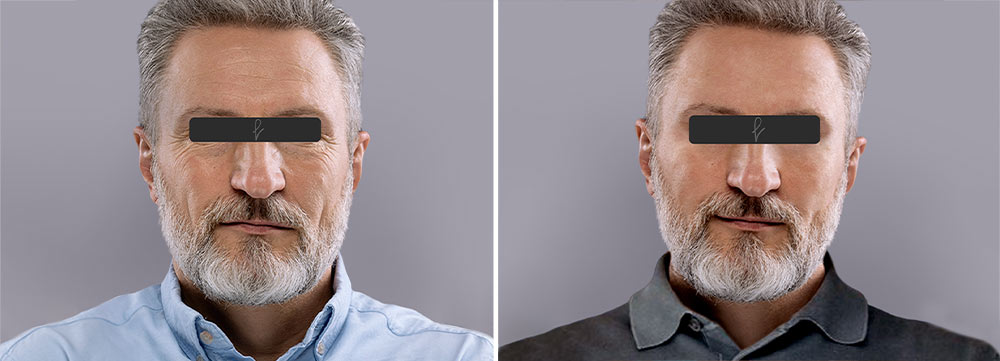 Resultados del Lifting Facial