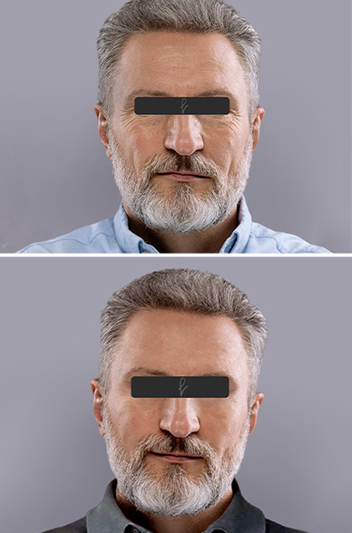 Resultados del Lifting Facial