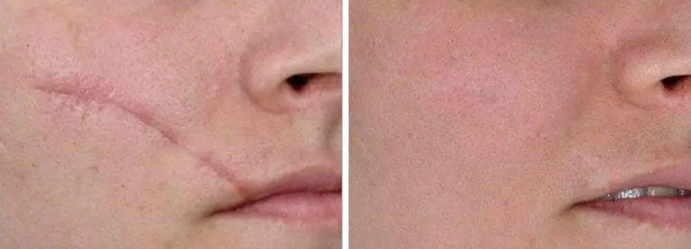 antes y despues eliminar cicatriz