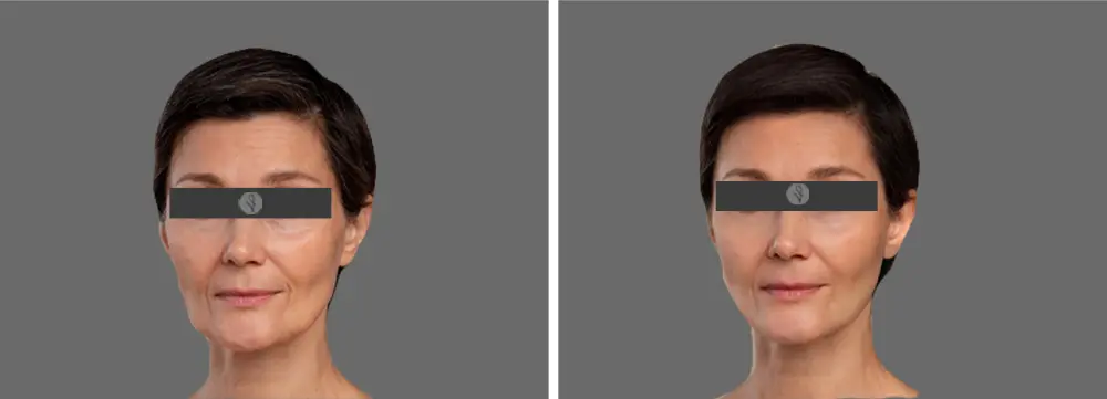 Resultados del Botox Facial