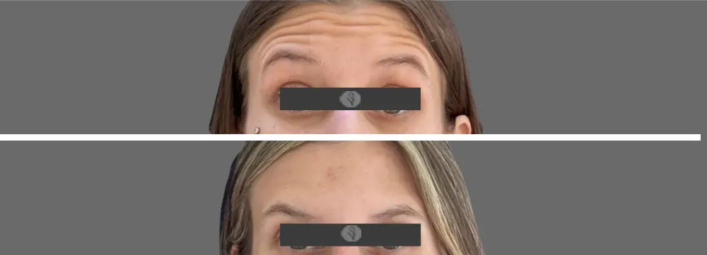 Resultados del Botox en Frente
