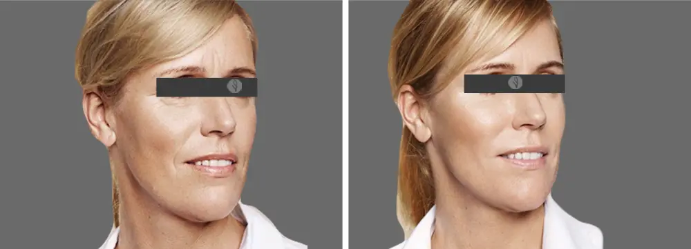 Resultados del Botox Facial