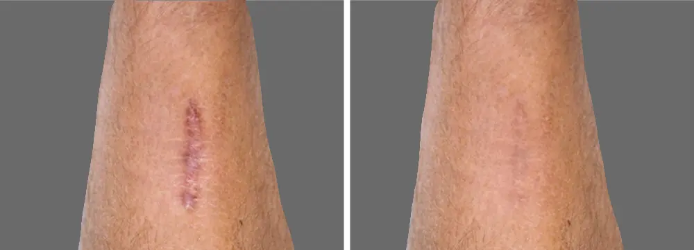antes y despues eliminar cicatriz