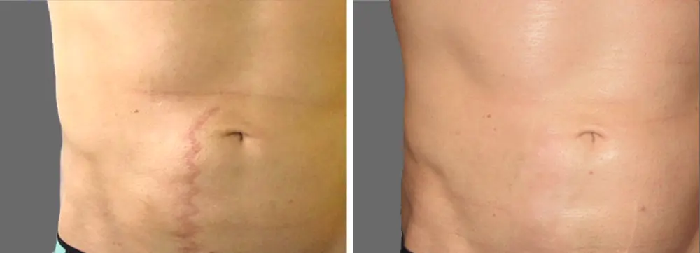antes y despues eliminar cicatriz