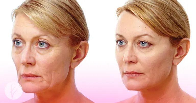 Cómo el lifting facial combate la flacidez