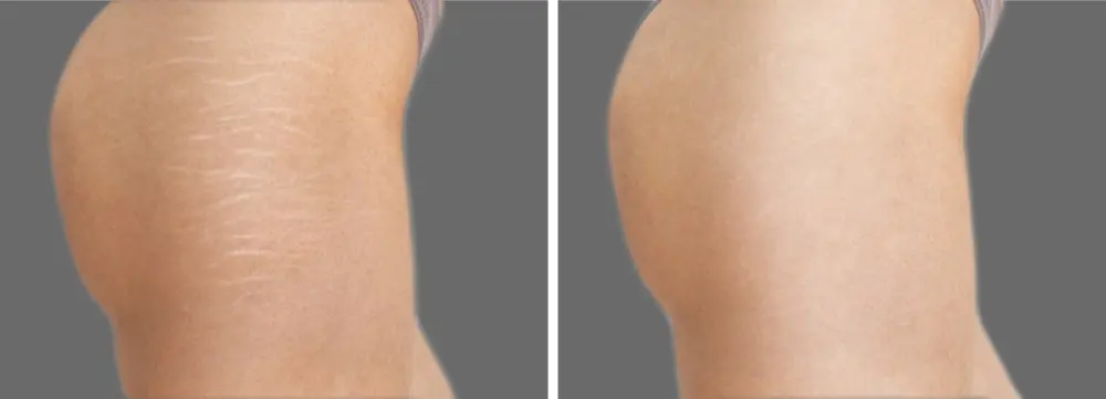antes y despues de Laser Co2