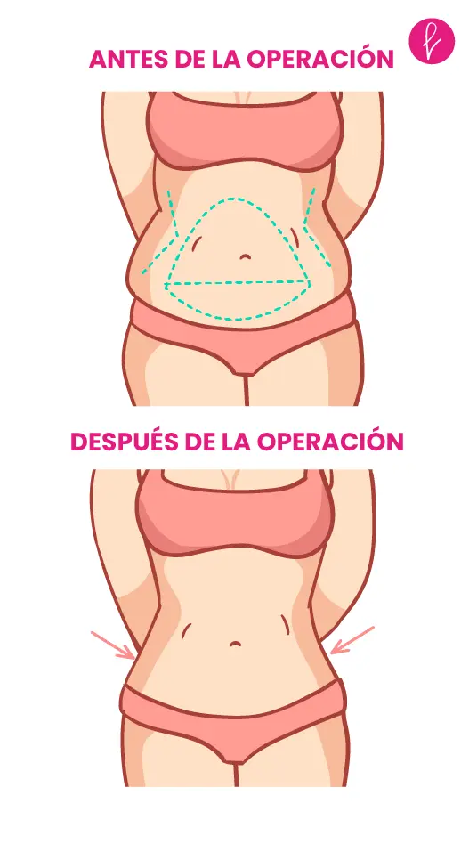 Abdominoplastia Resultados Abdominoplastia Resultados