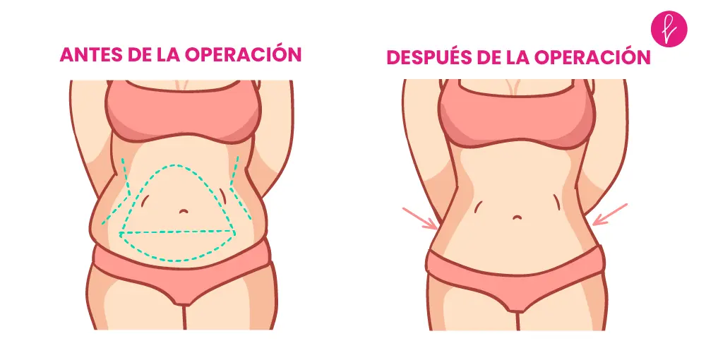 Abdominoplastia Resultados Abdominoplastia Resultados