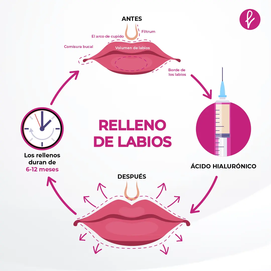 ¿Cómo se realiza el procedimiento para colocar ácido hialurónico? ¿Cómo se realiza el procedimiento para colocar ácido hialurónico?