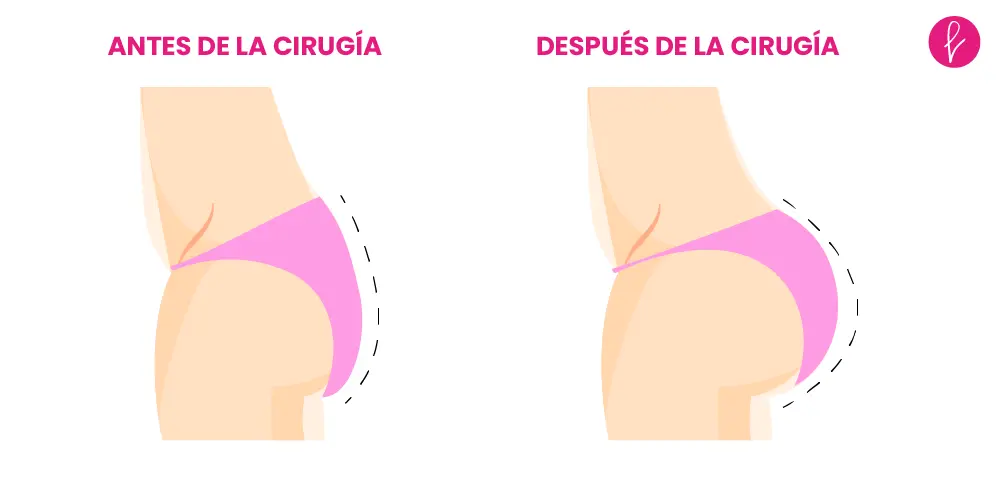 Gluteoplastia Resultados