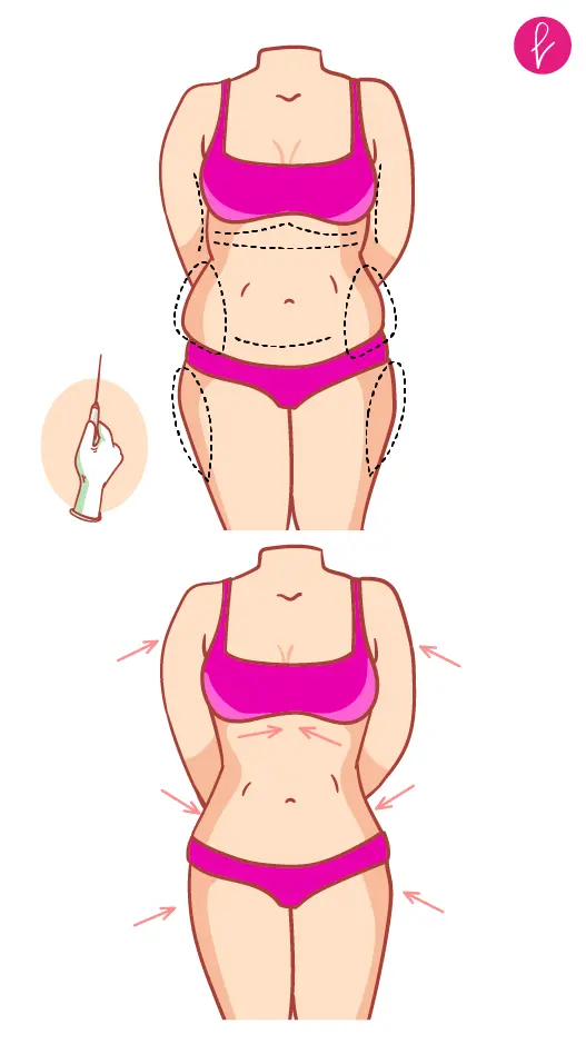 Procedimiento de Liposucción Procedimiento de Liposucción