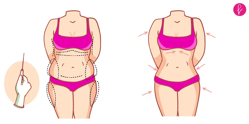 Procedimiento de Liposucción Procedimiento de Liposucción