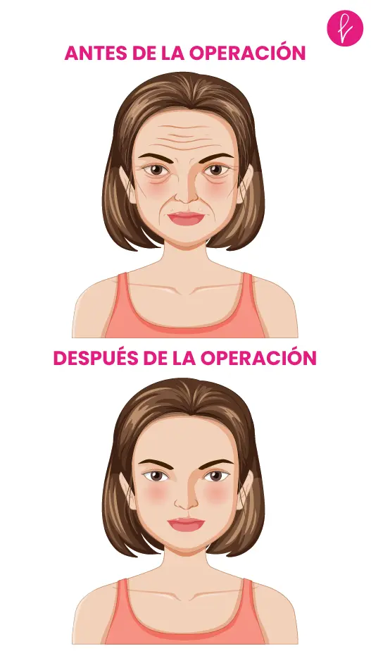 Lifting facial resultados Lifting facial resultados