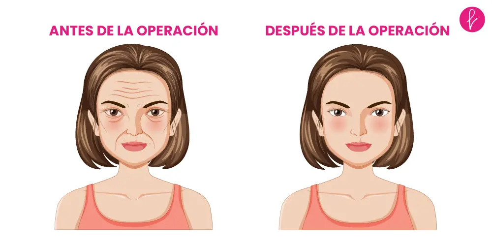 Lifting facial resultados Lifting facial resultados