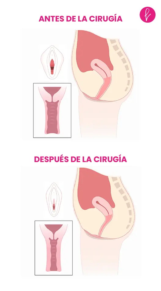 Vaginoplastia Resultados