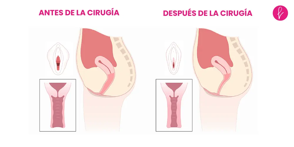 Vaginoplastia Resultados