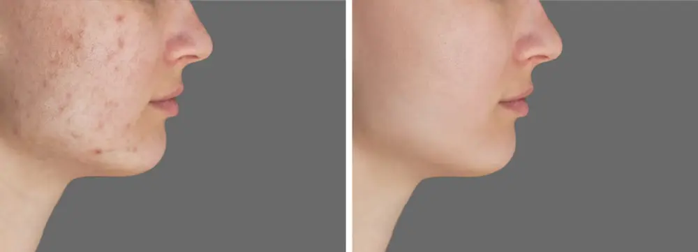 antes y despues de Laser Co2