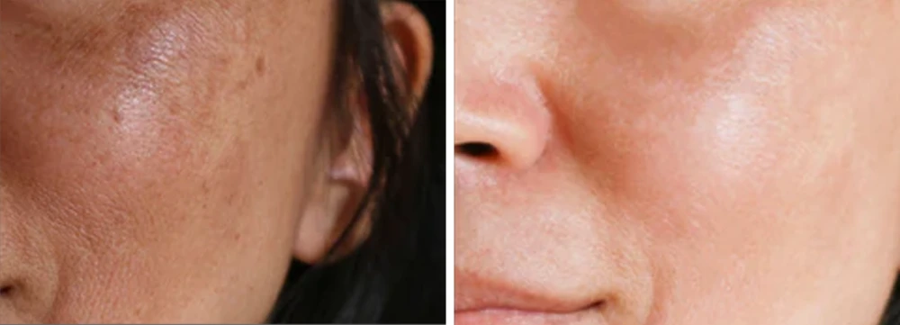 antes y despues de Laser Co2