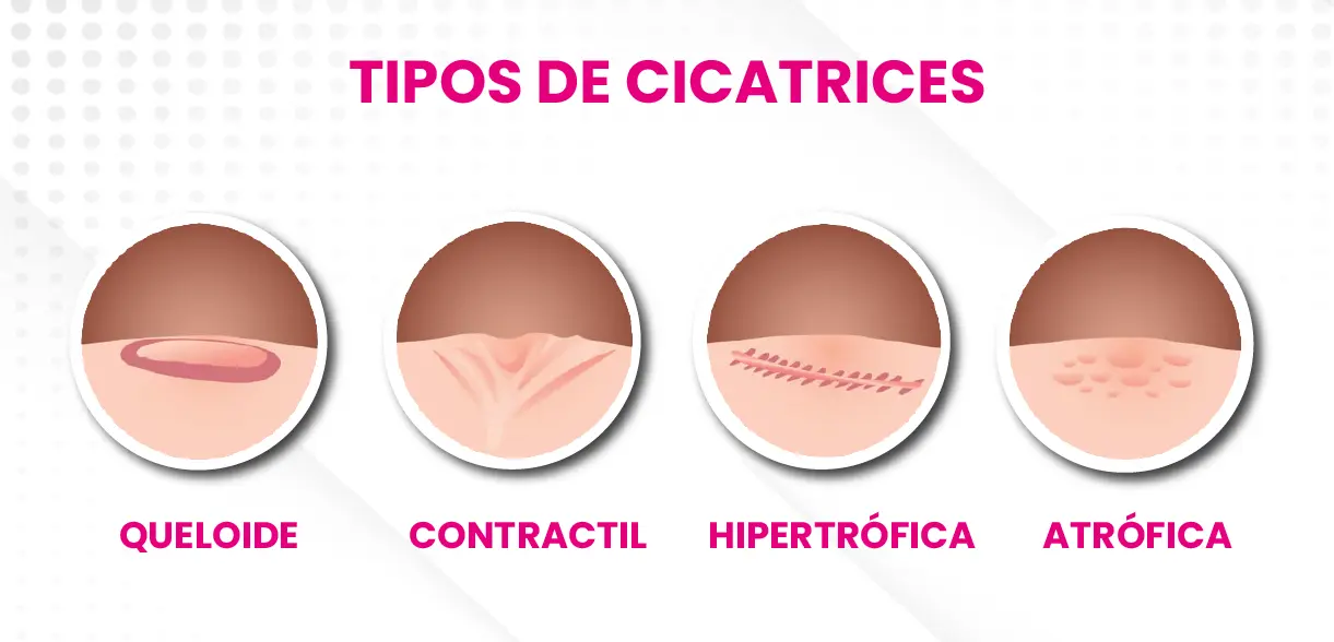 Tipos de Cicatriz
