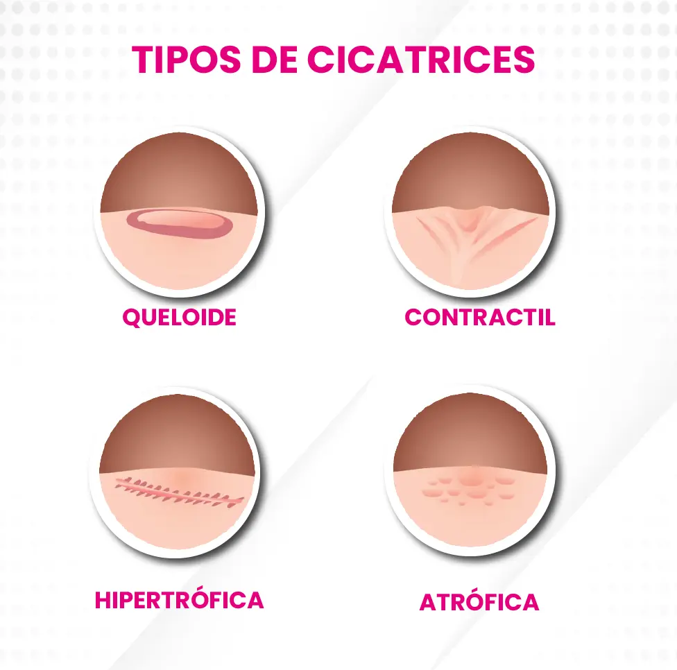 Tipos de Cicatriz