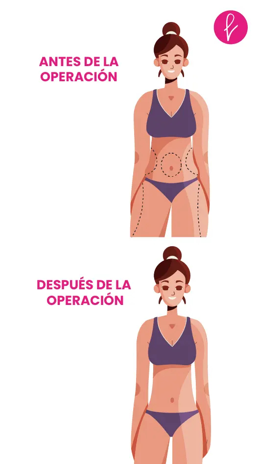 Lipoescultura Resultados Lipoescultura Resultados
