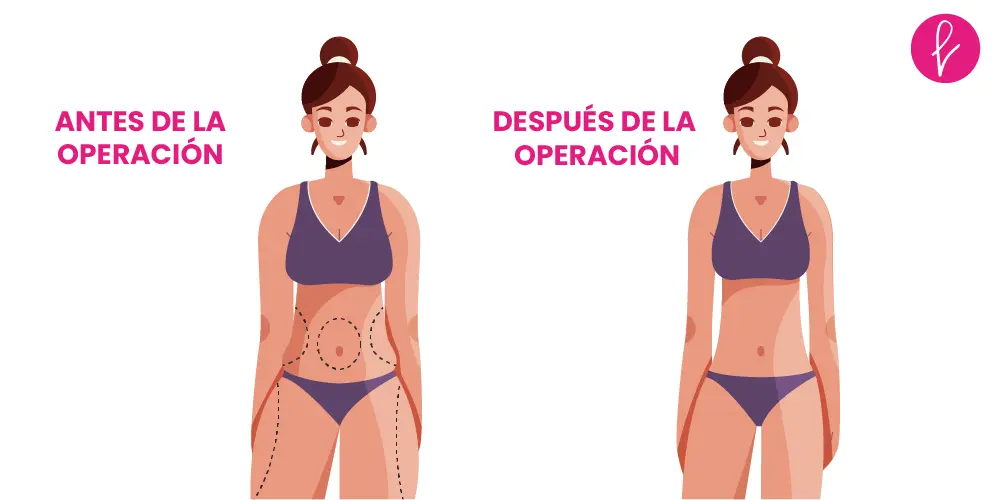 Lipoescultura Resultados Lipoescultura Resultados