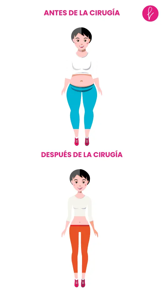 Liposucción resultados Liposucción resultados