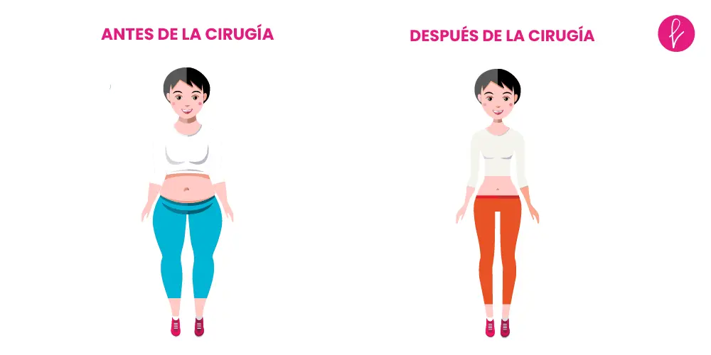 Liposucción resultados Liposucción resultados