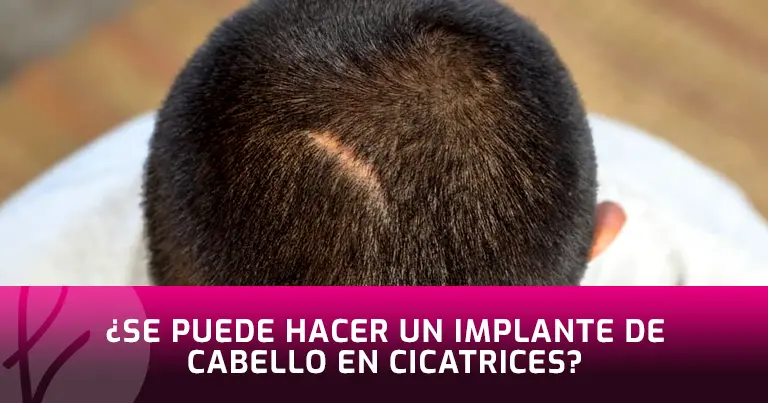 ¿Se puede hacer un implante de cabello en Cicatrices?