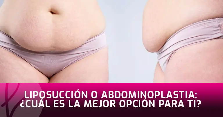 Liposucción o Abdominoplastia: ¿Cuál es la mejor opción para ti?