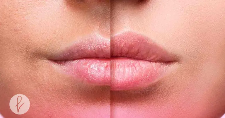 Ácido hialurónico: Resultados inmediatos y naturales