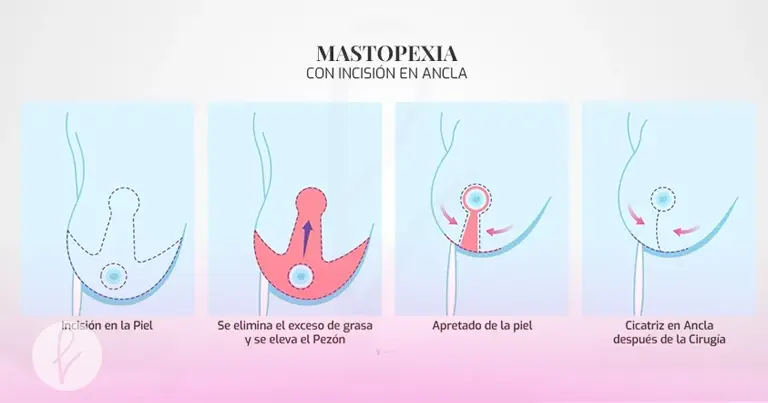 Tipos de mastopexia según el grado de caída