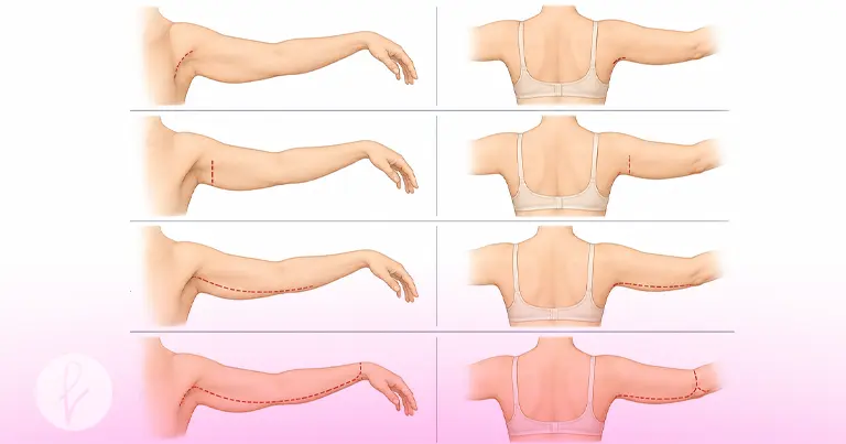 Tipos de lifting de brazos