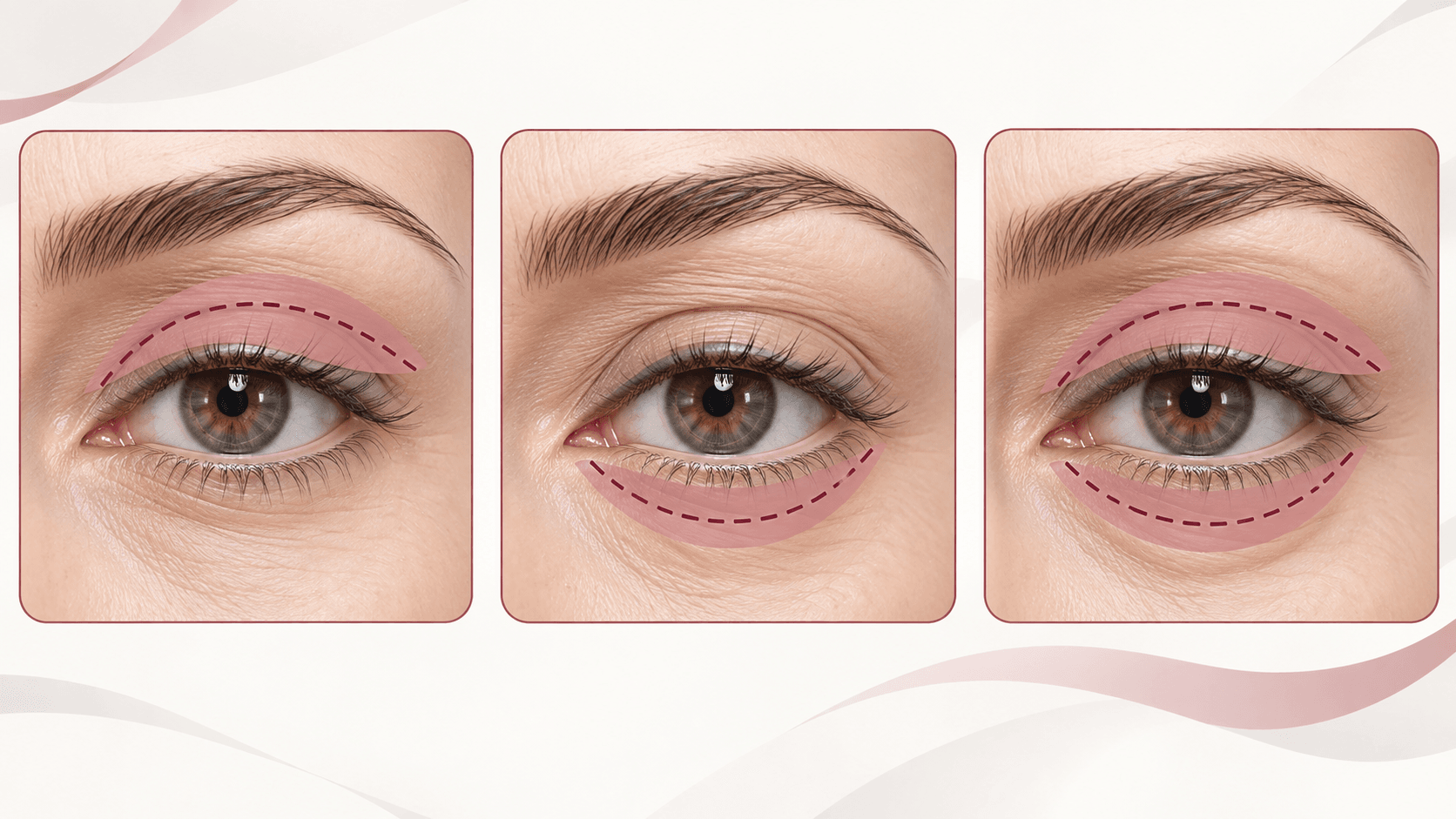 Comparación entre blefaroplastia superior, inferior y completa