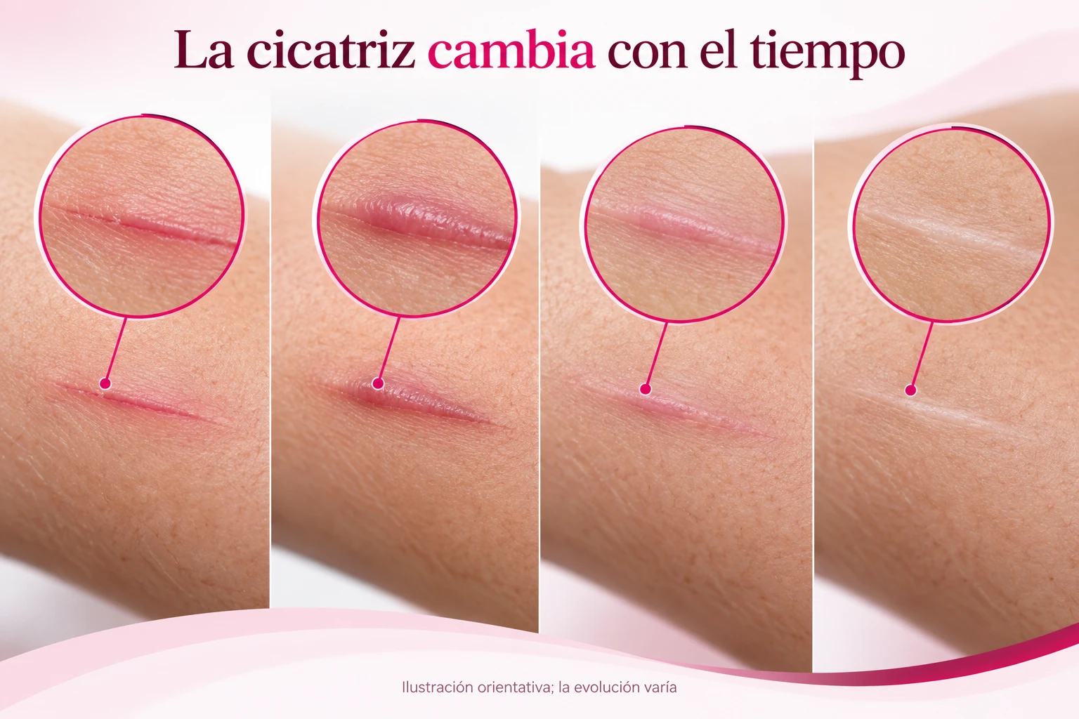 Etapas ilustrativas del cambio de color y relieve de una cicatriz